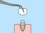 dental implants