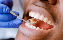 BellevueDental bridges